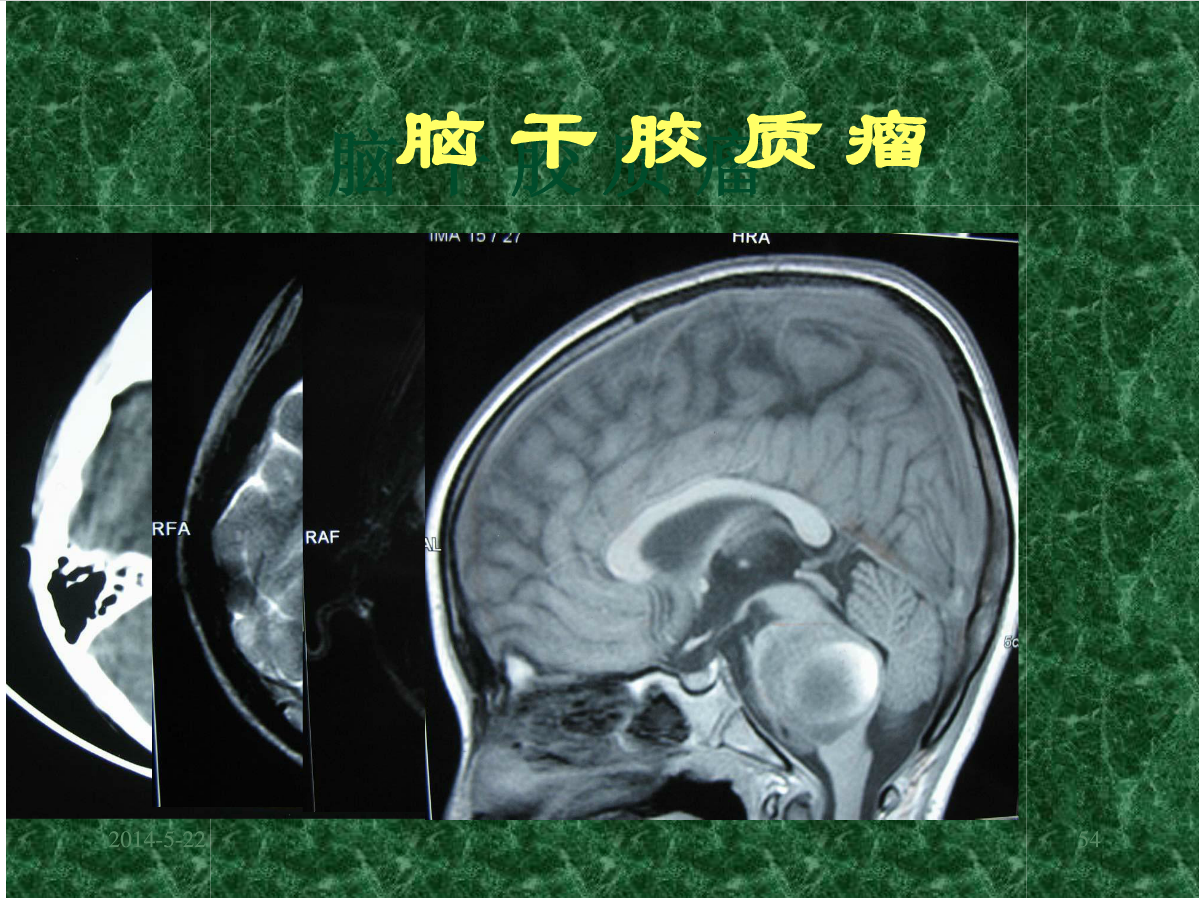 MRI成像在中枢神经系统的应用