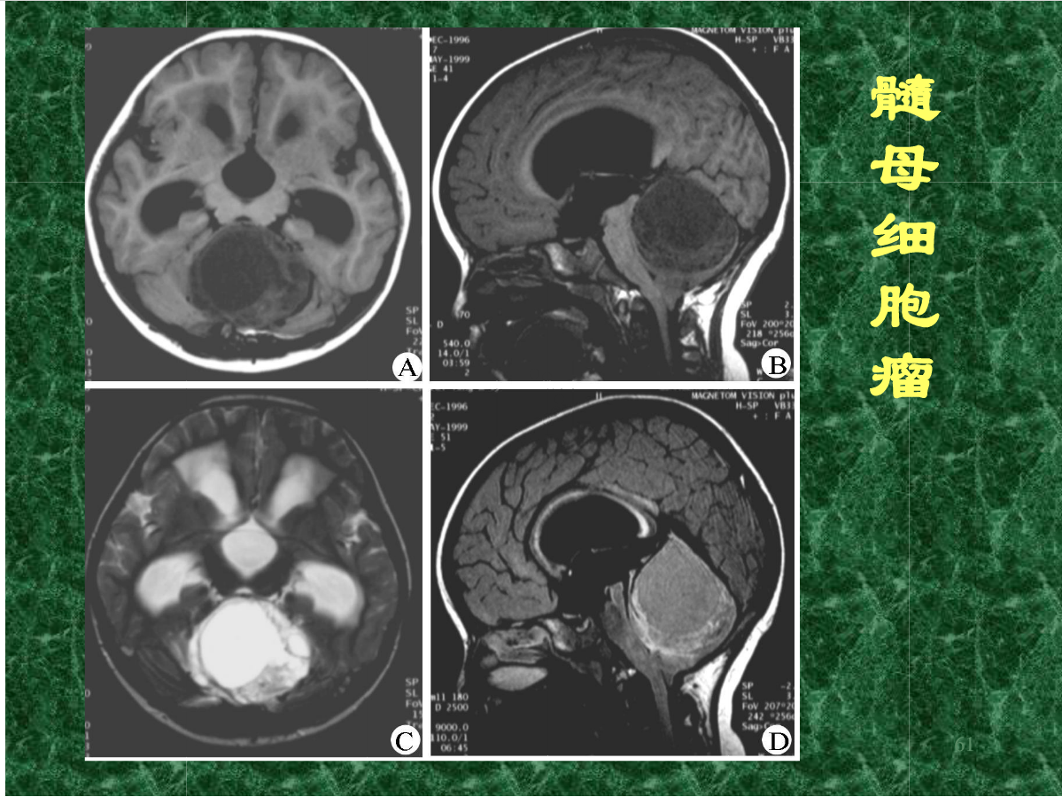 MRI成像在中枢神经系统的应用