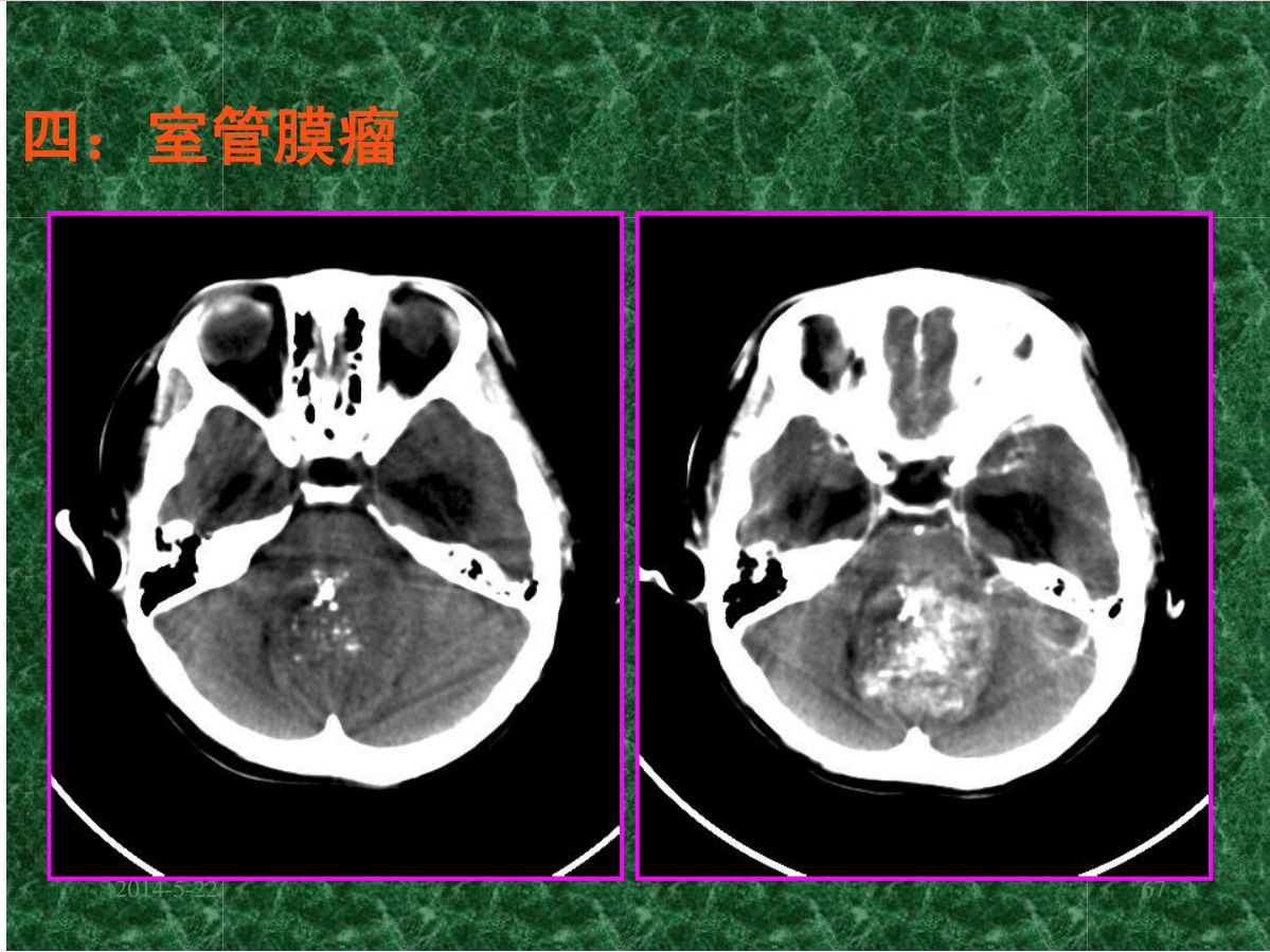 MRI成像在中枢神经系统的应用