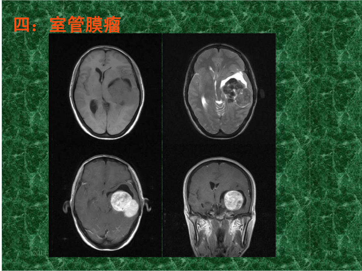 MRI成像在中枢神经系统的应用