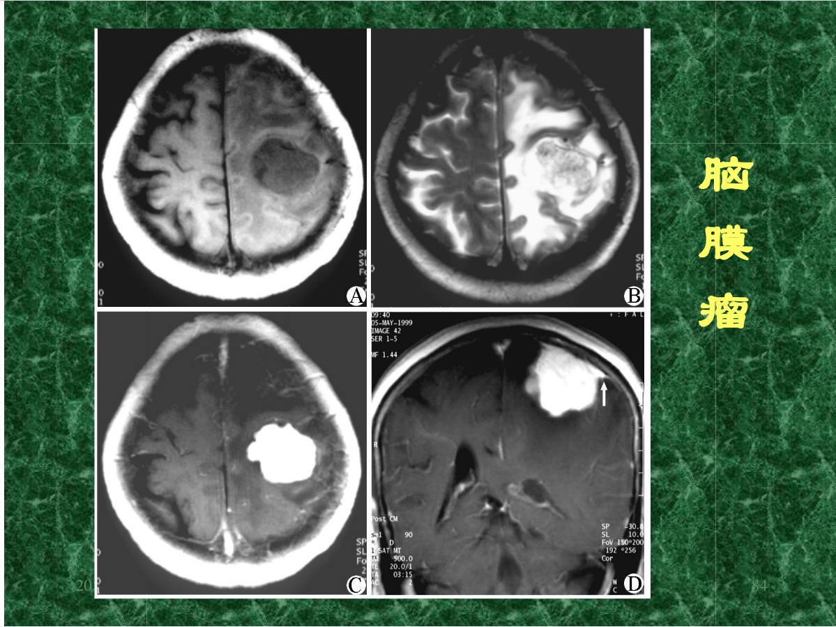 MRI成像在中枢神经系统的应用