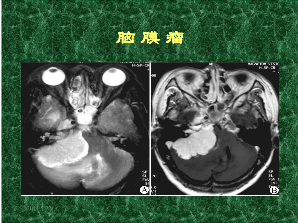 MRI成像在中枢神经系统的应用