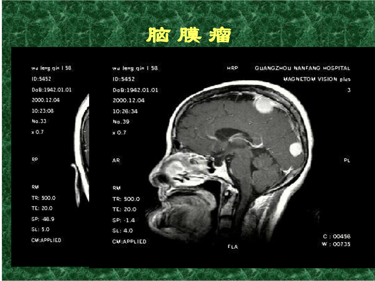 MRI成像在中枢神经系统的应用