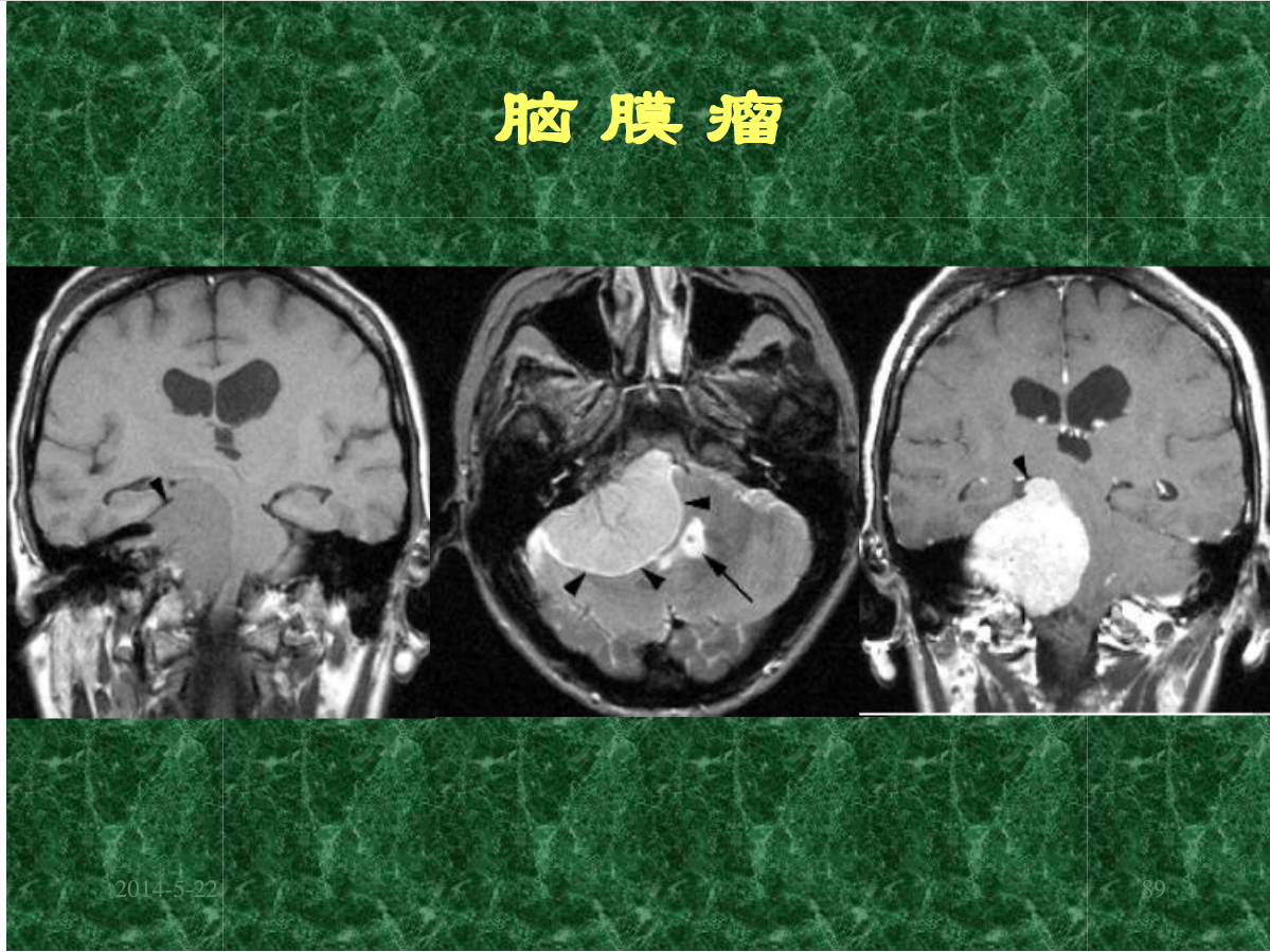 MRI成像在中枢神经系统的应用