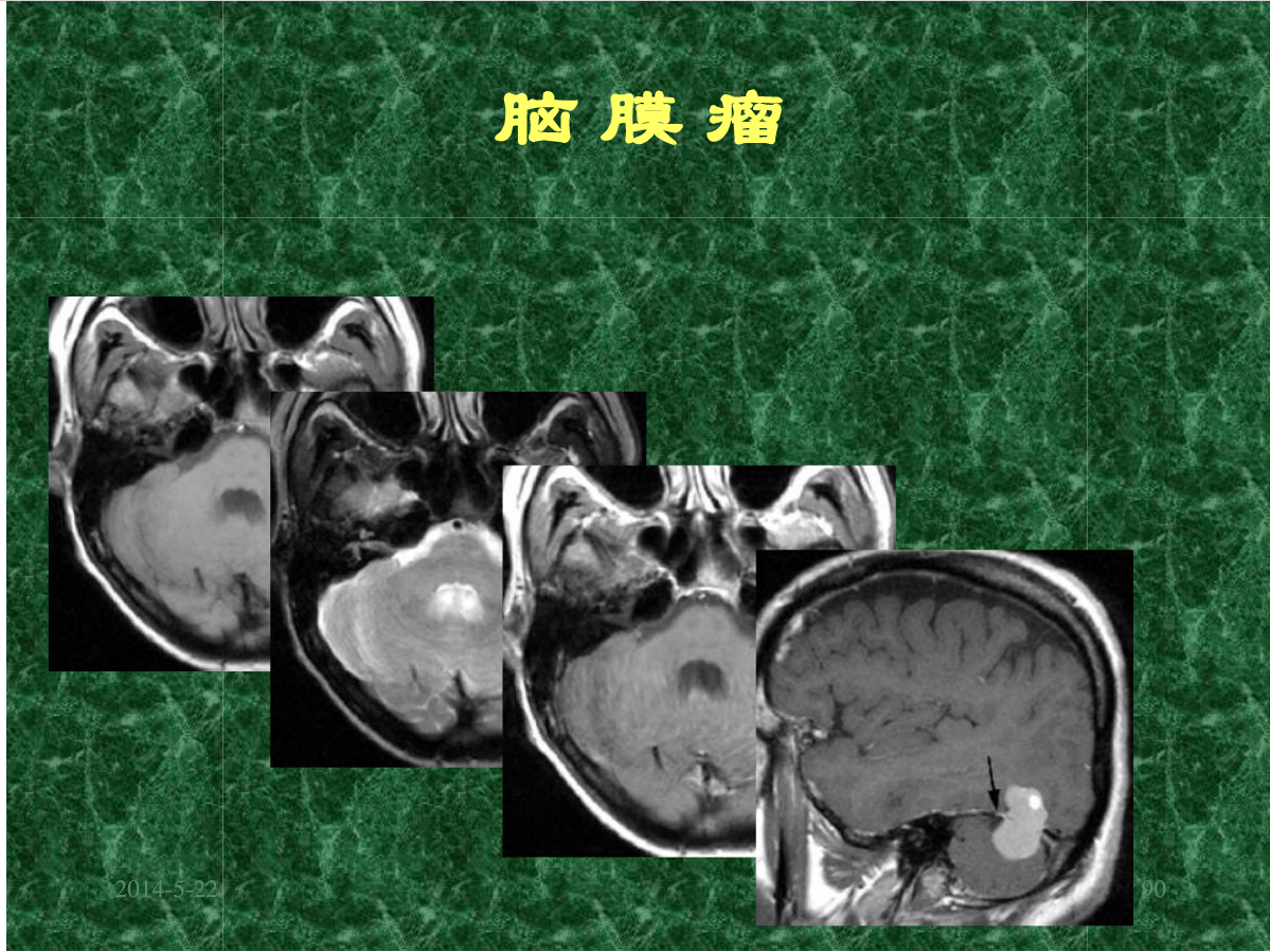 MRI成像在中枢神经系统的应用