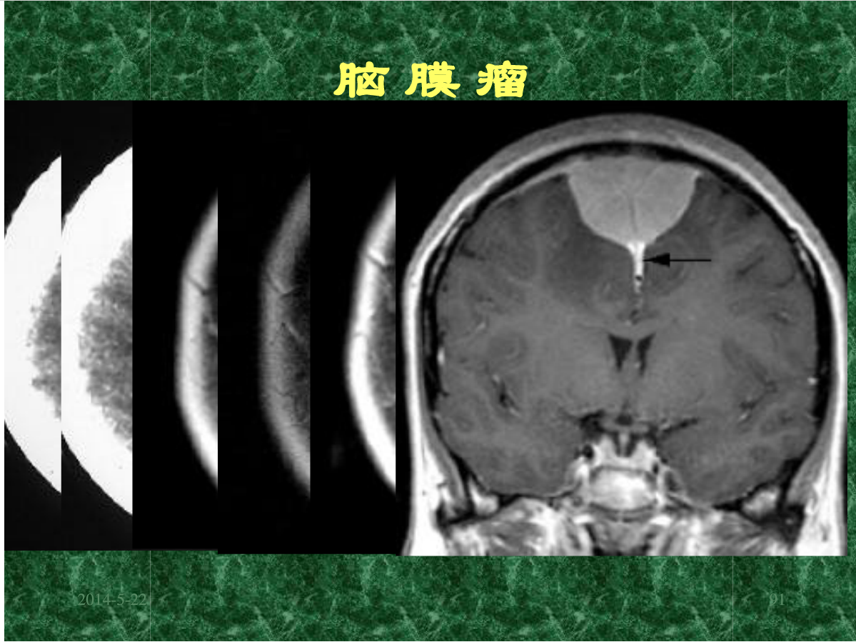 MRI成像在中枢神经系统的应用