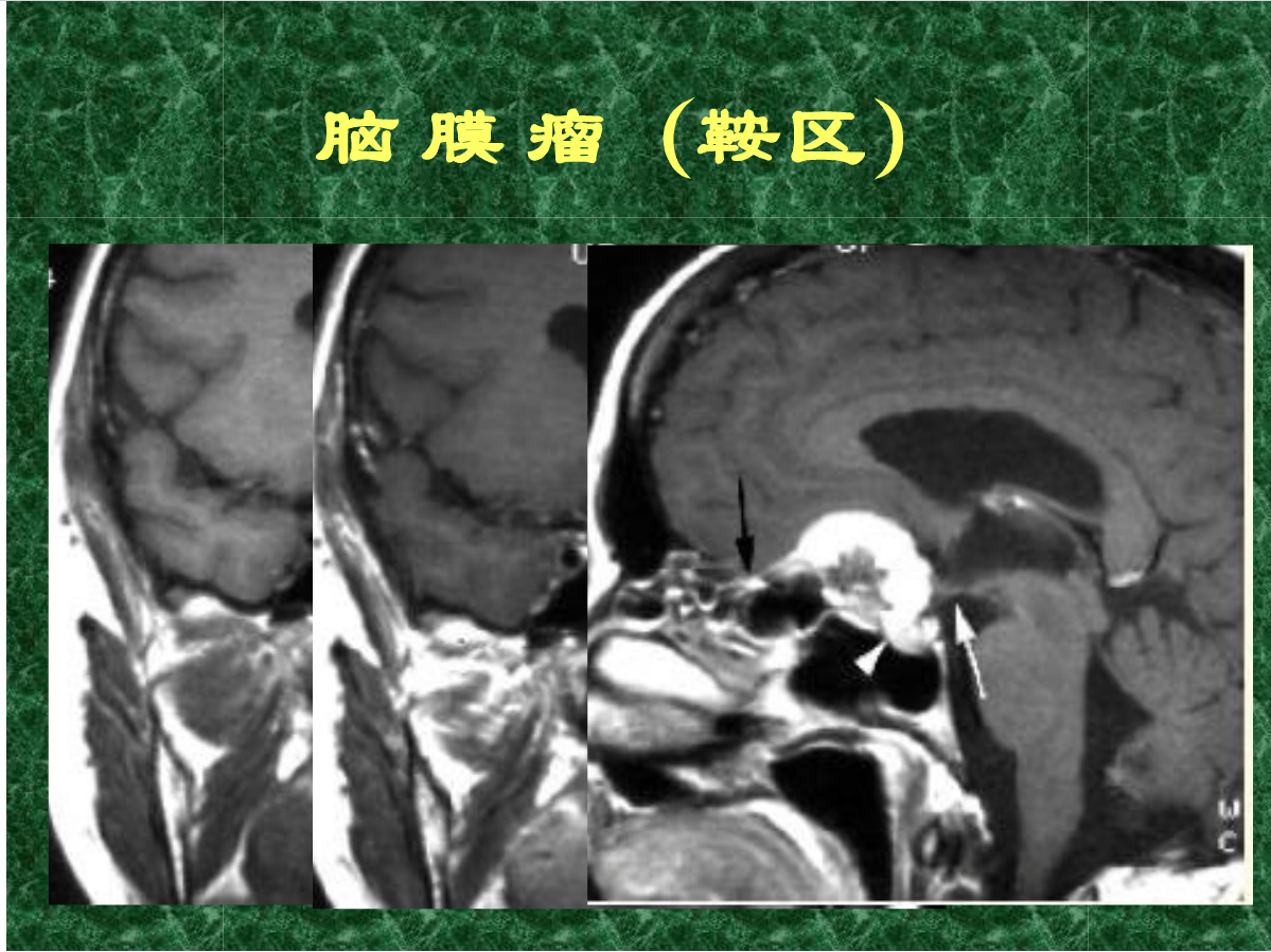 MRI成像在中枢神经系统的应用
