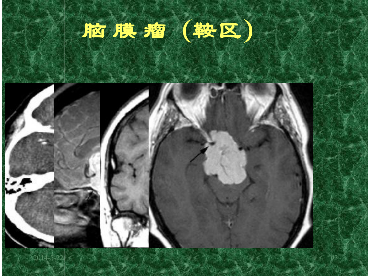 MRI成像在中枢神经系统的应用