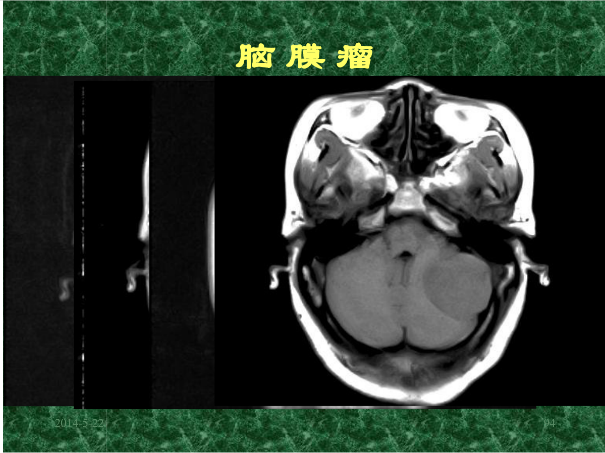 MRI成像在中枢神经系统的应用