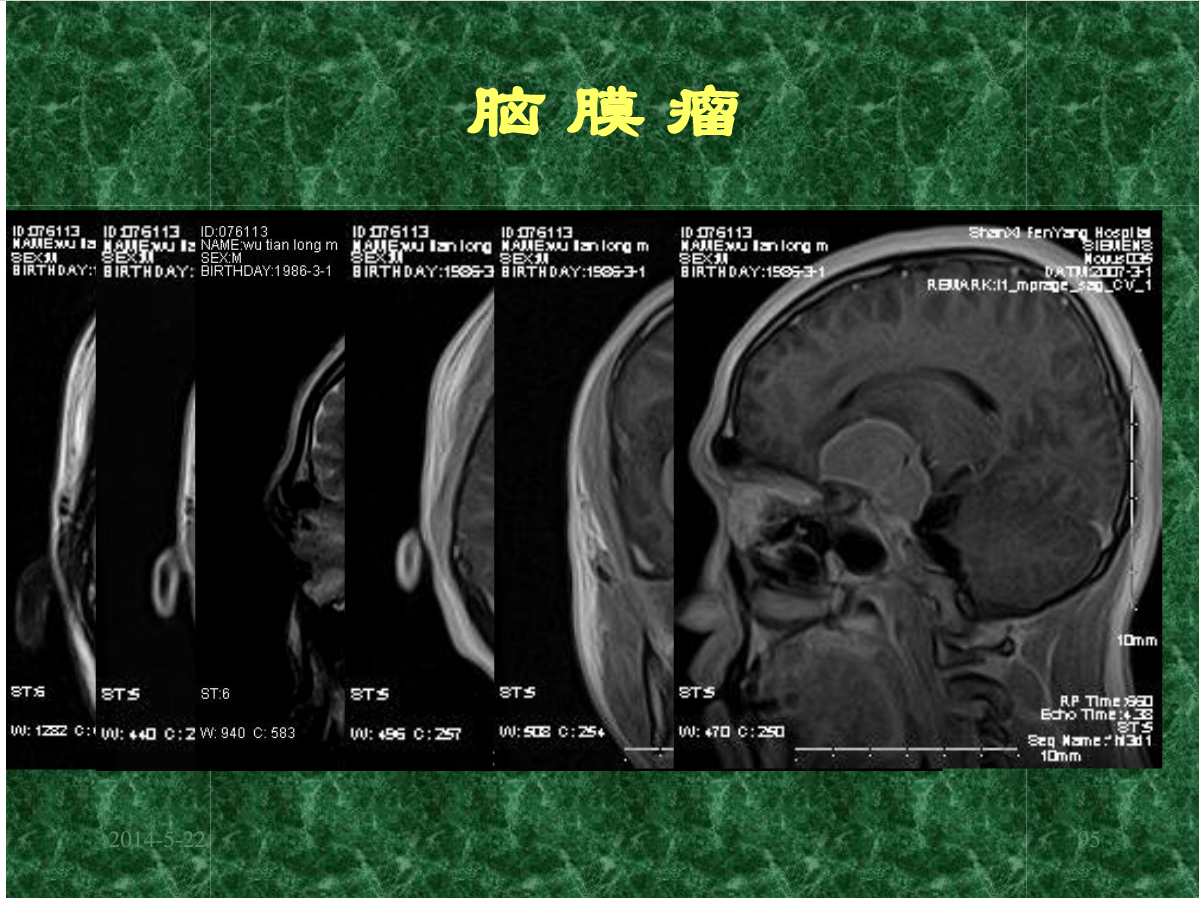 MRI成像在中枢神经系统的应用