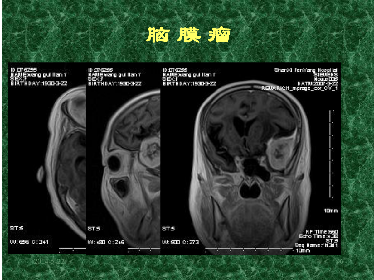 MRI成像在中枢神经系统的应用