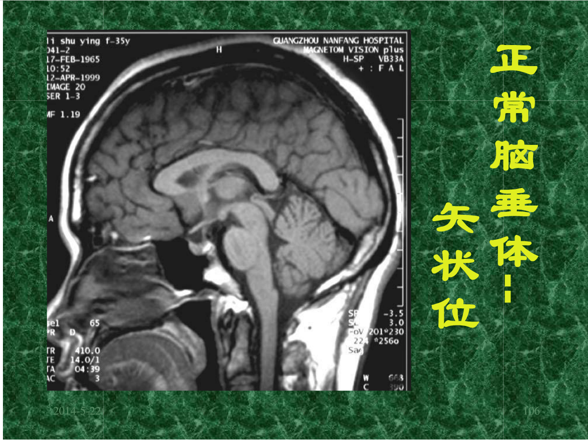 MRI成像在中枢神经系统的应用