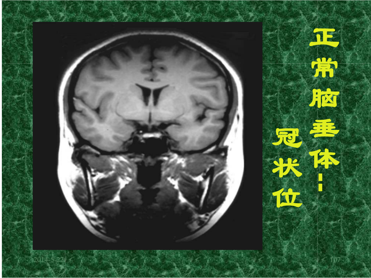 MRI成像在中枢神经系统的应用