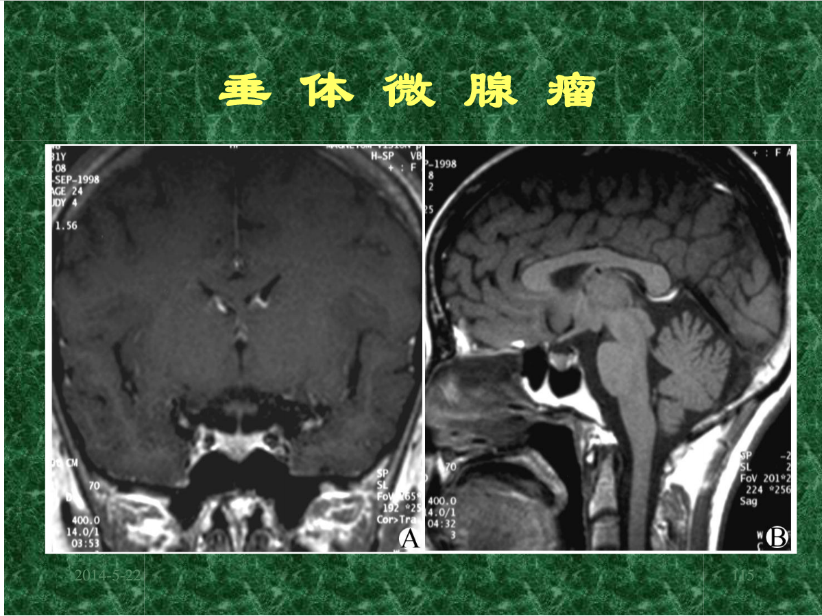 MRI成像在中枢神经系统的应用