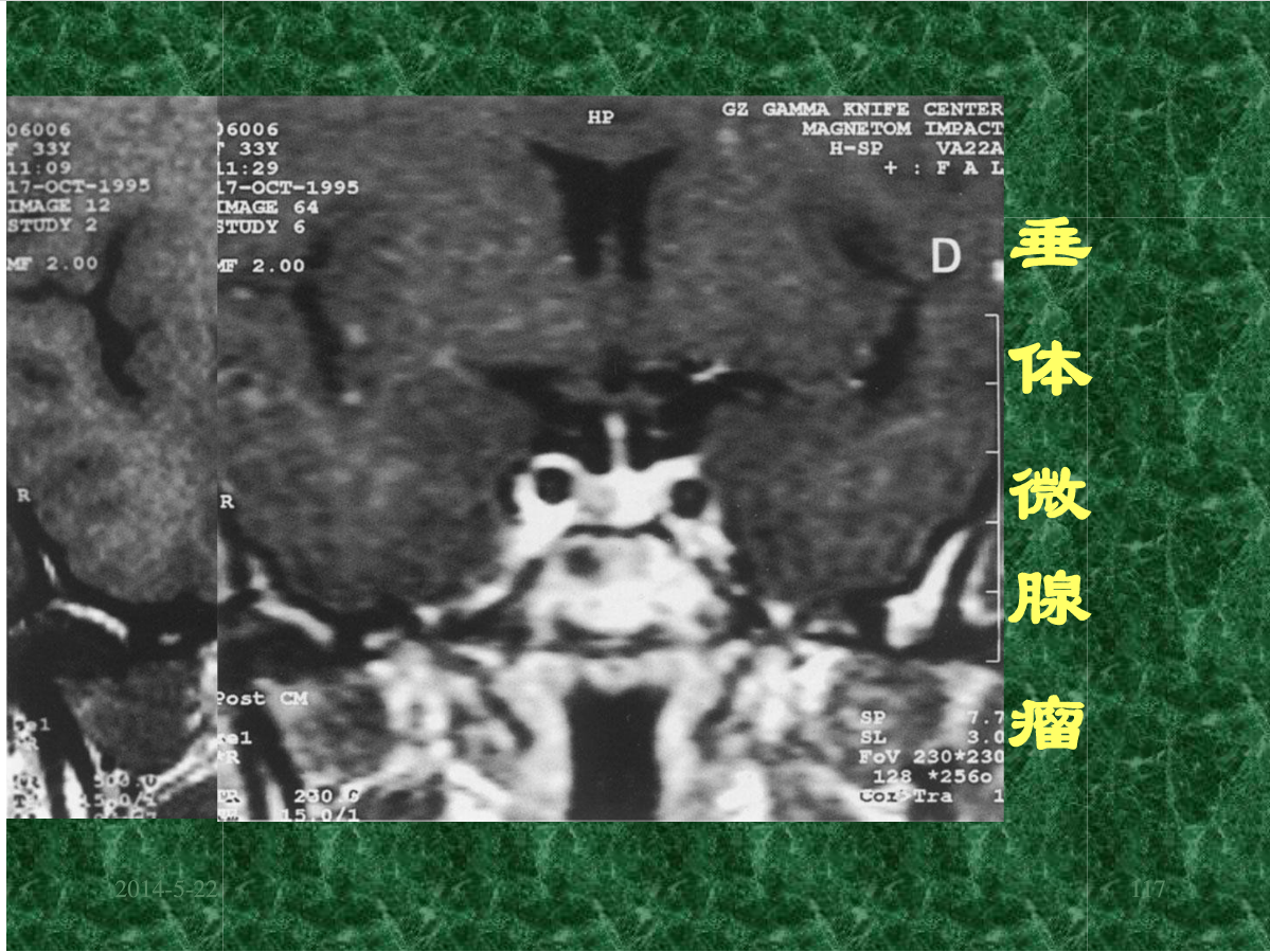 MRI成像在中枢神经系统的应用