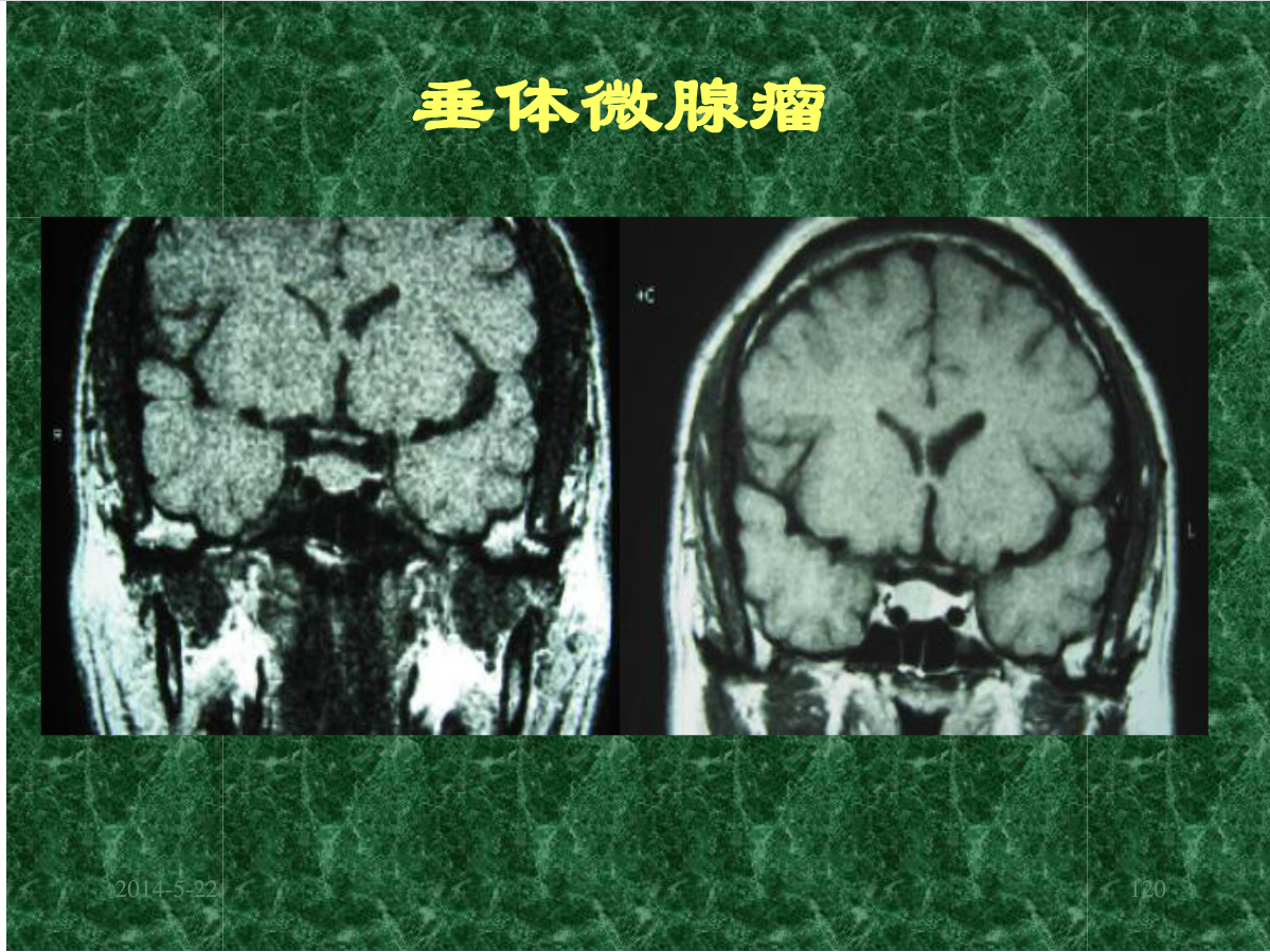 MRI成像在中枢神经系统的应用