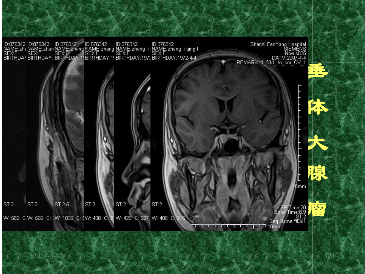 MRI成像在中枢神经系统的应用