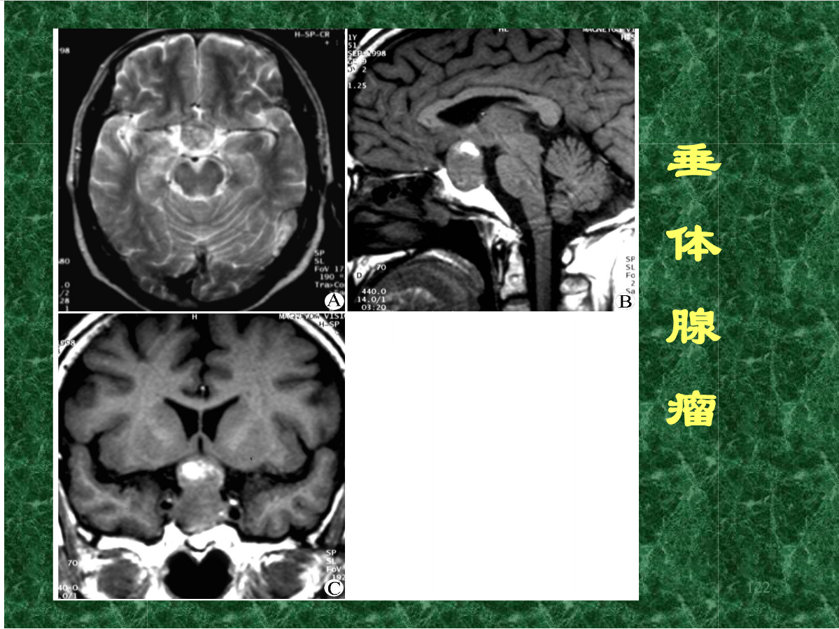 MRI成像在中枢神经系统的应用