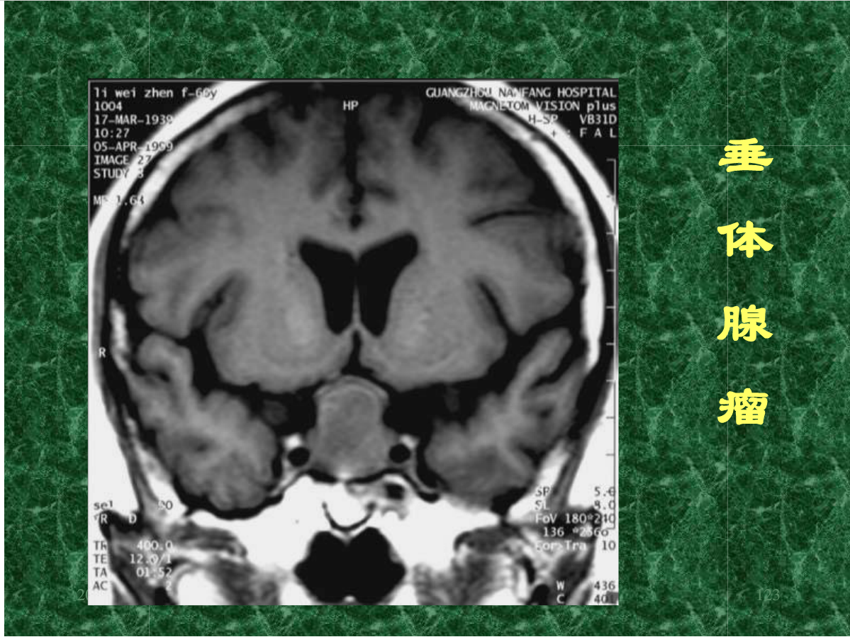 MRI成像在中枢神经系统的应用