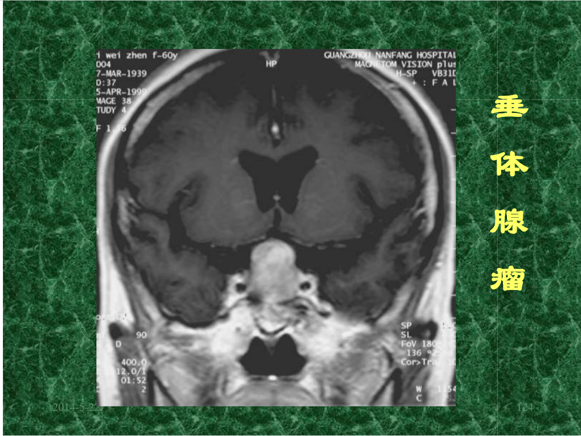 MRI成像在中枢神经系统的应用