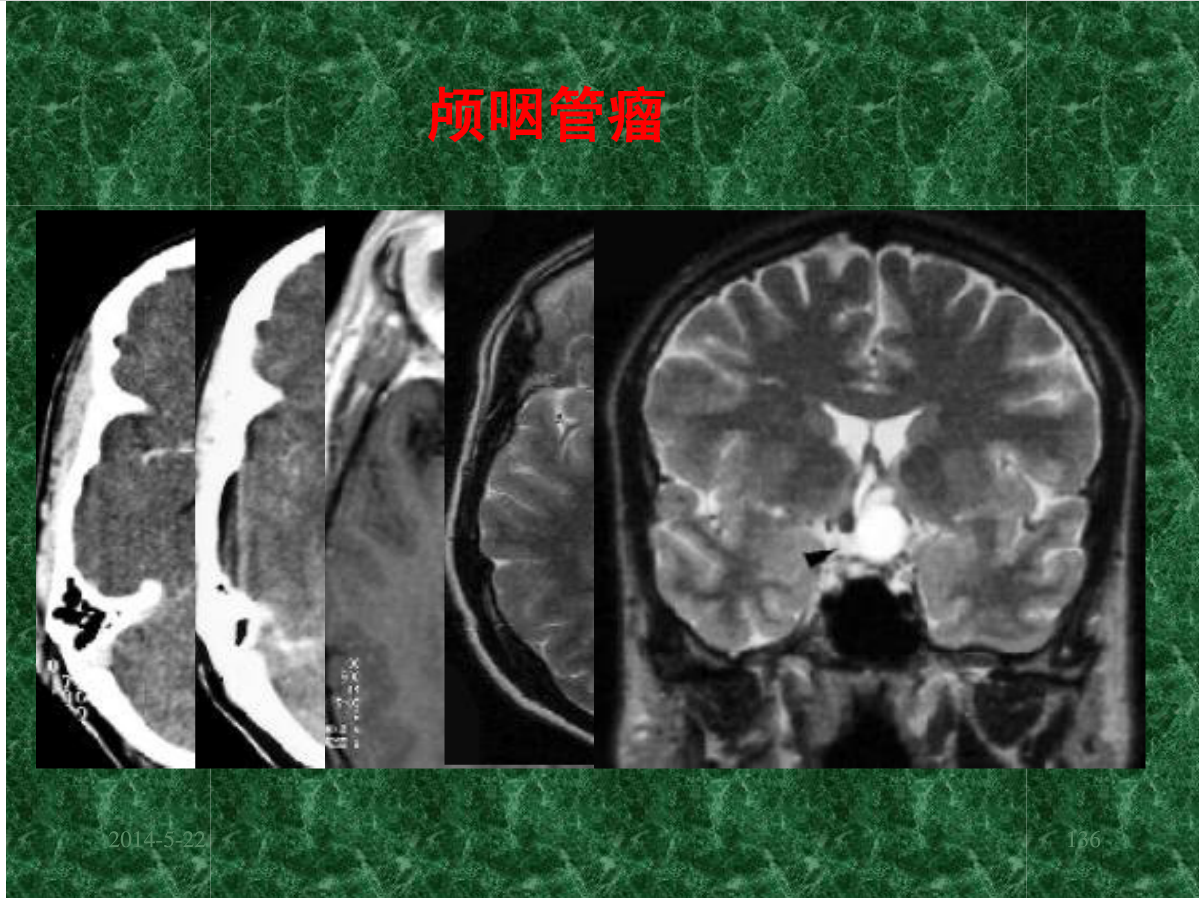 MRI成像在中枢神经系统的应用