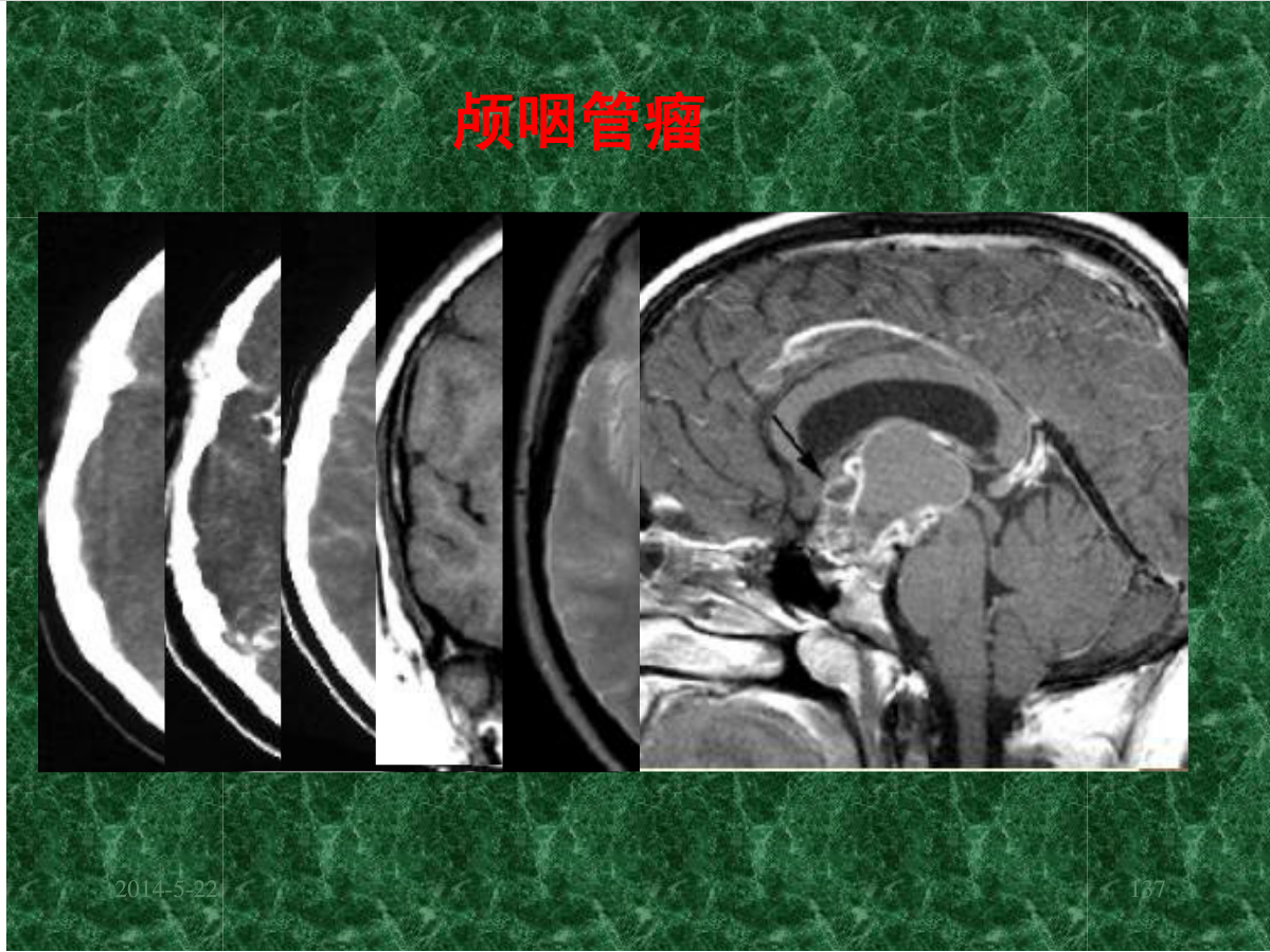 MRI成像在中枢神经系统的应用