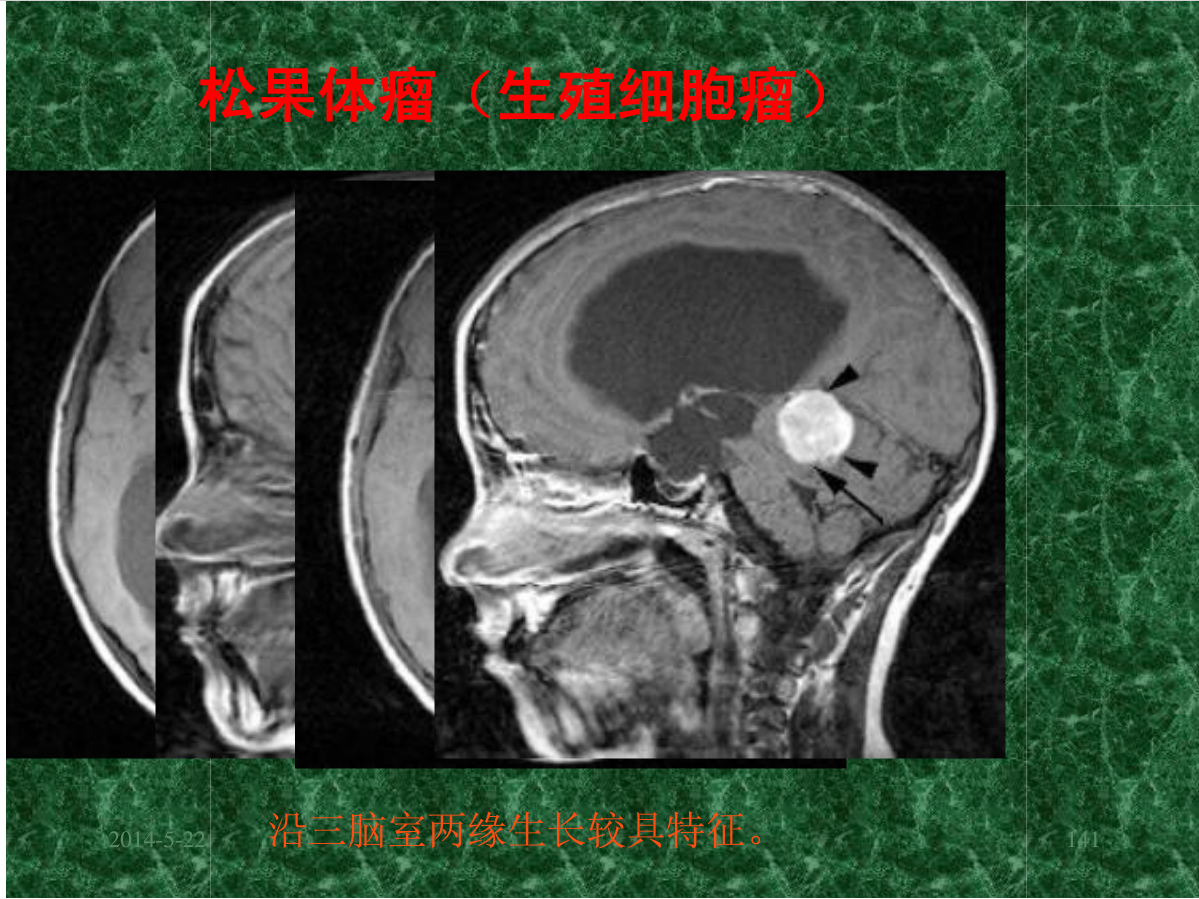 MRI成像在中枢神经系统的应用