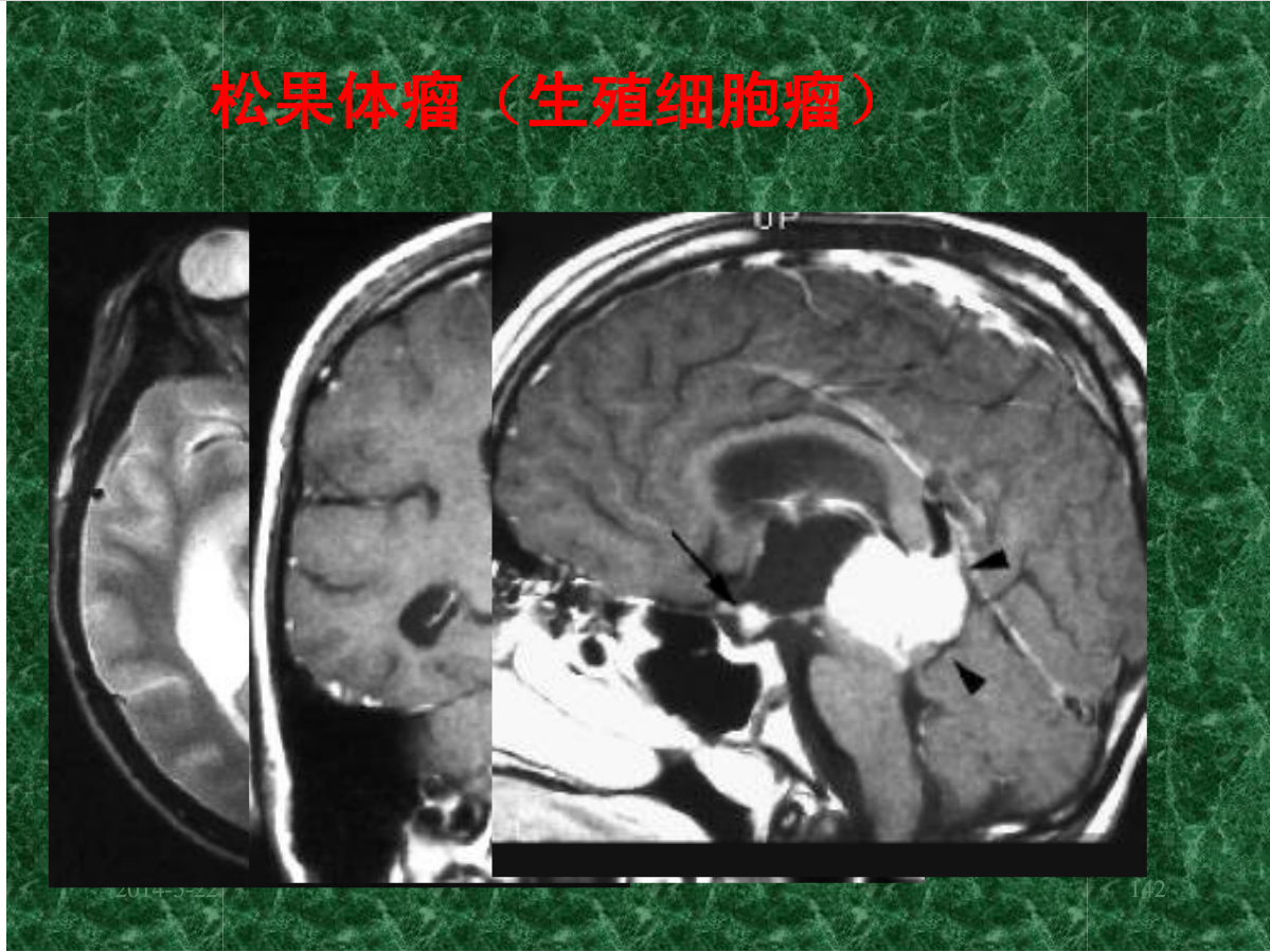 MRI成像在中枢神经系统的应用