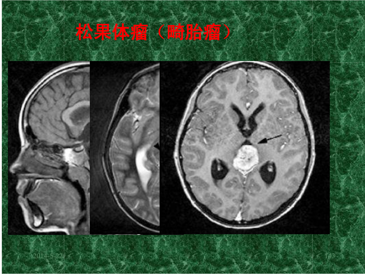 MRI成像在中枢神经系统的应用