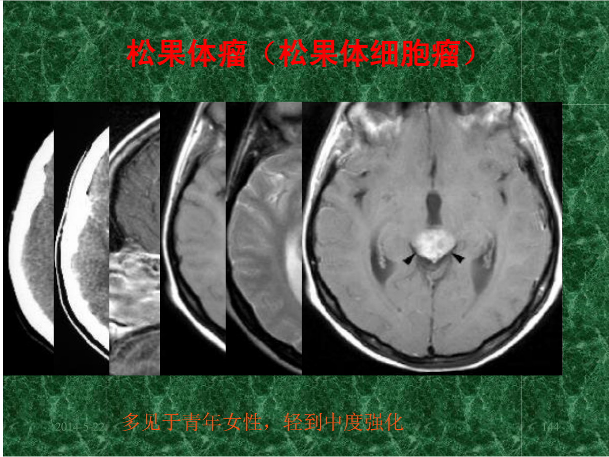 MRI成像在中枢神经系统的应用