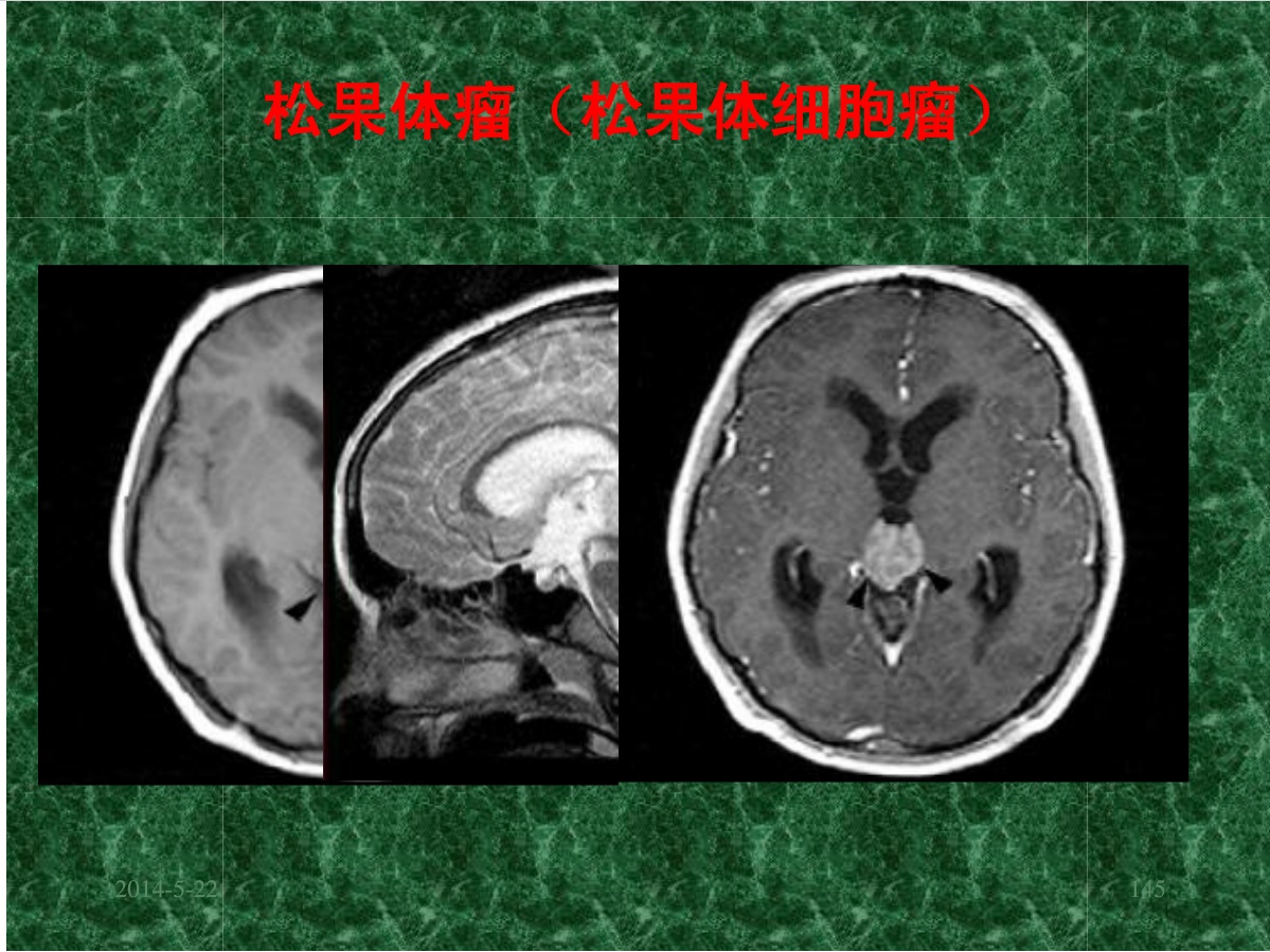 MRI成像在中枢神经系统的应用