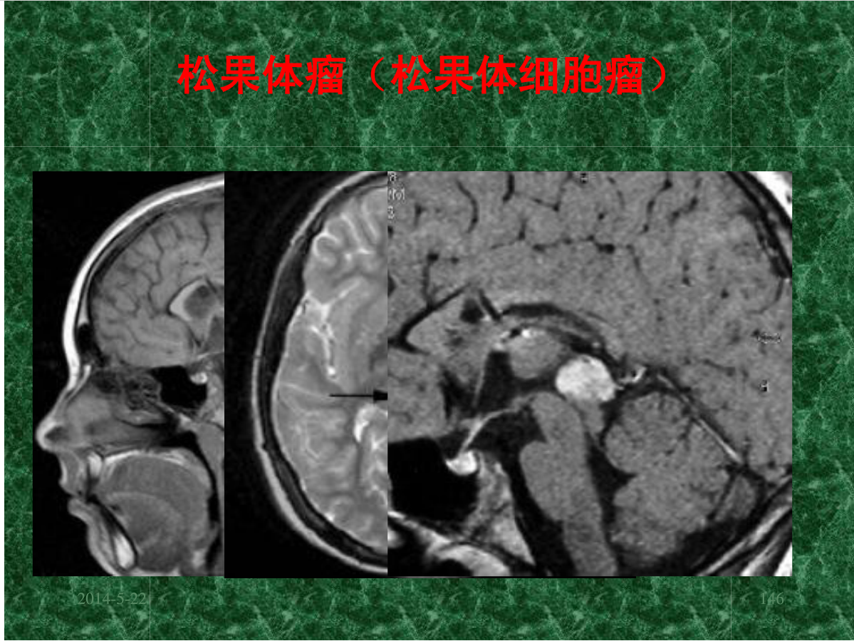 MRI成像在中枢神经系统的应用