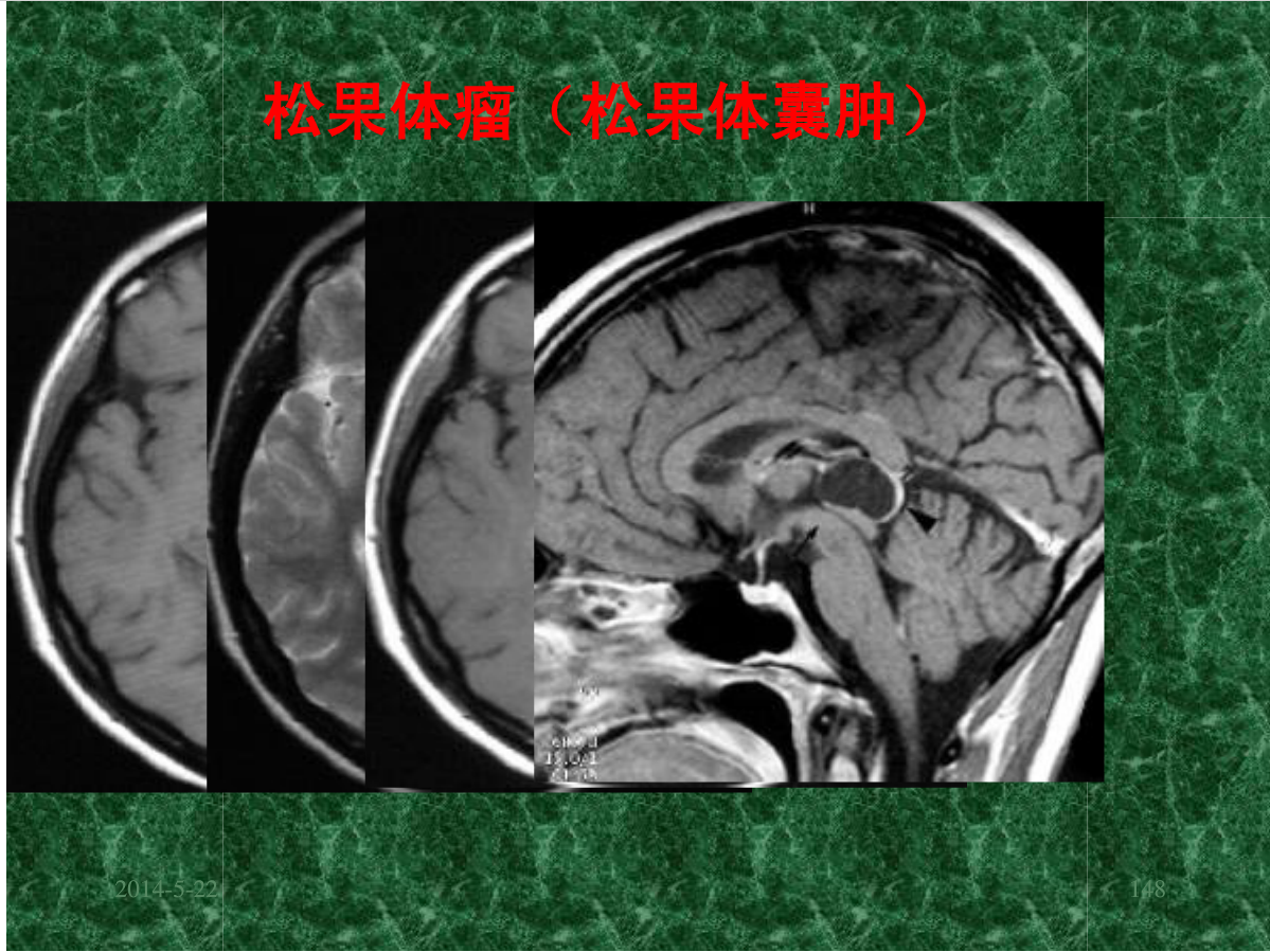 MRI成像在中枢神经系统的应用