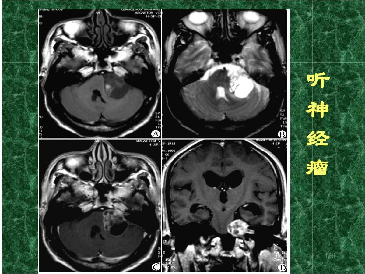 MRI成像在中枢神经系统的应用