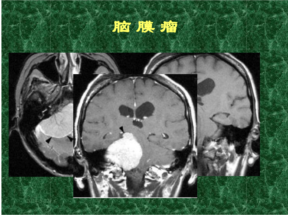 MRI成像在中枢神经系统的应用