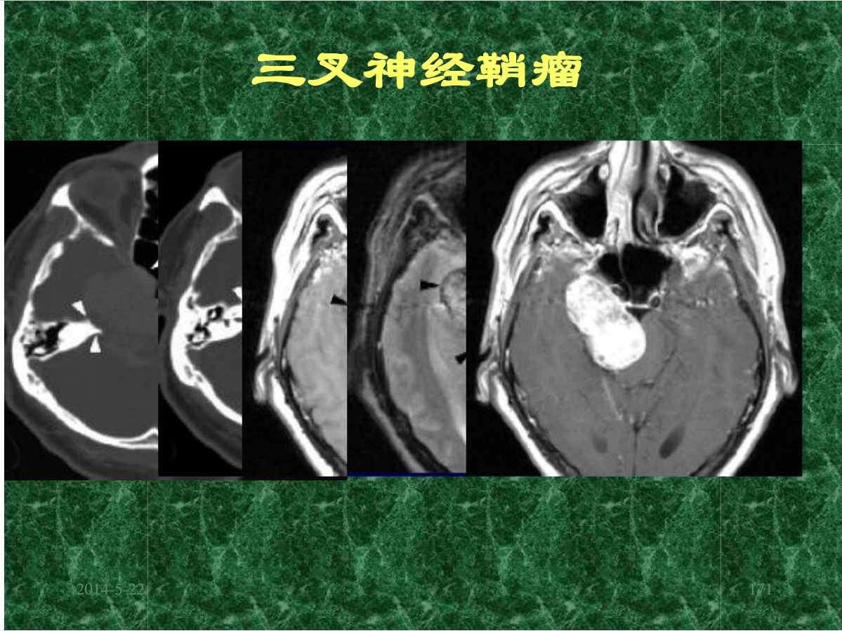MRI成像在中枢神经系统的应用