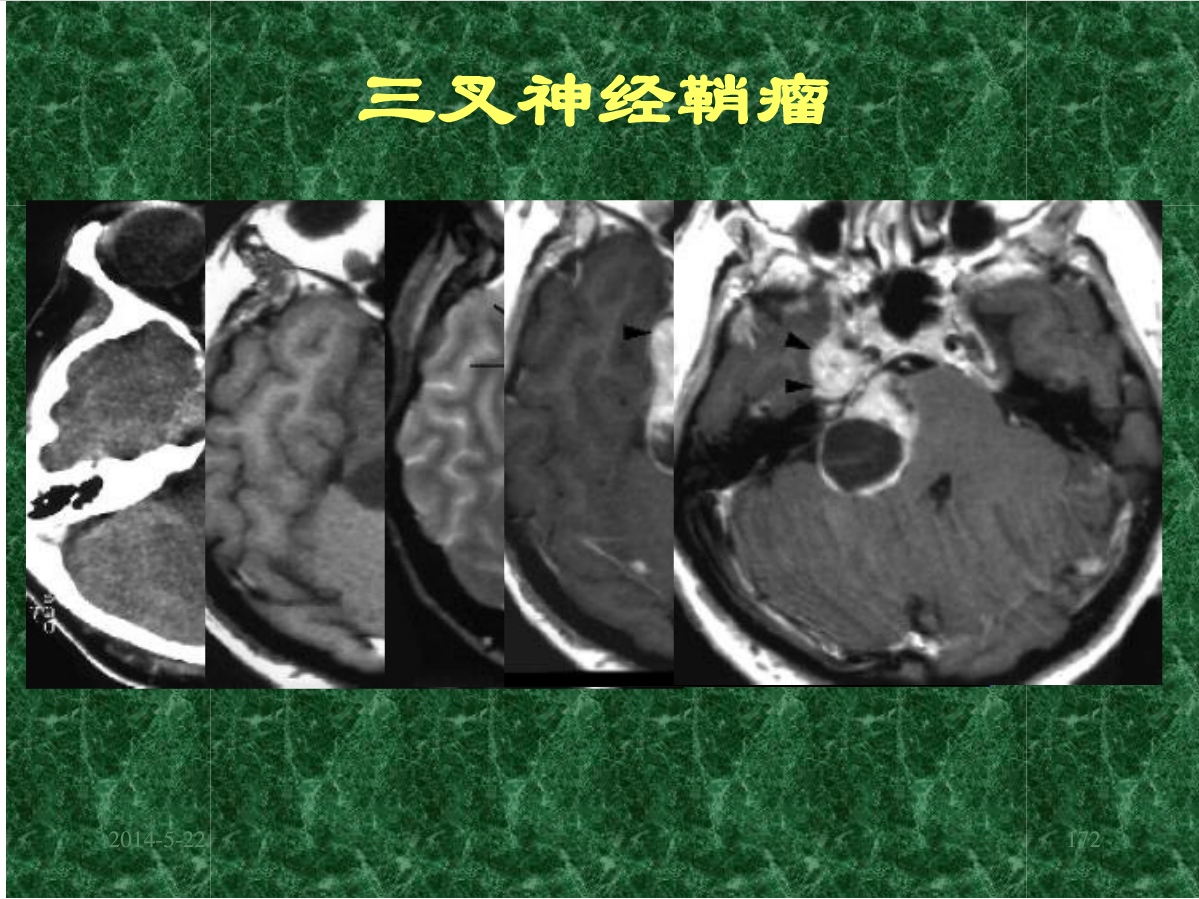 MRI成像在中枢神经系统的应用
