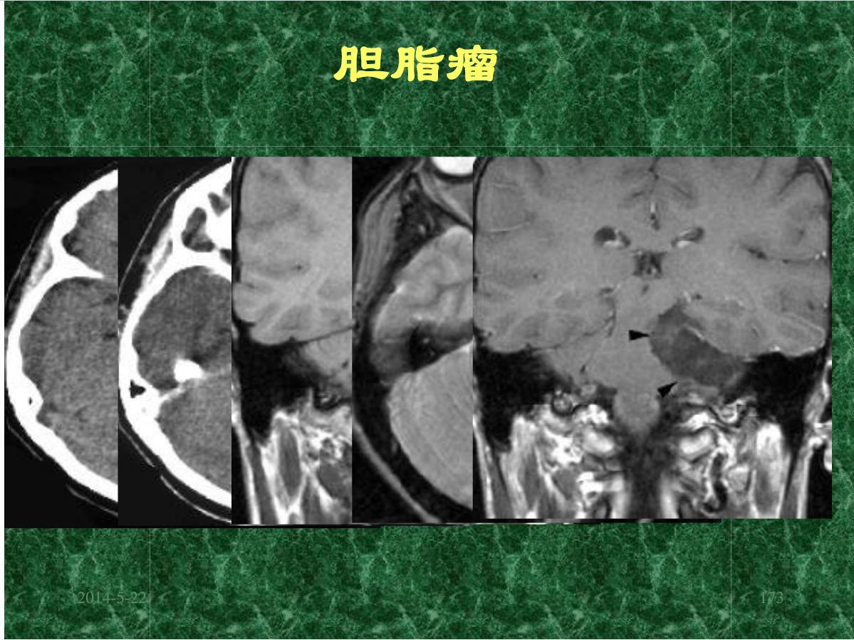 MRI成像在中枢神经系统的应用