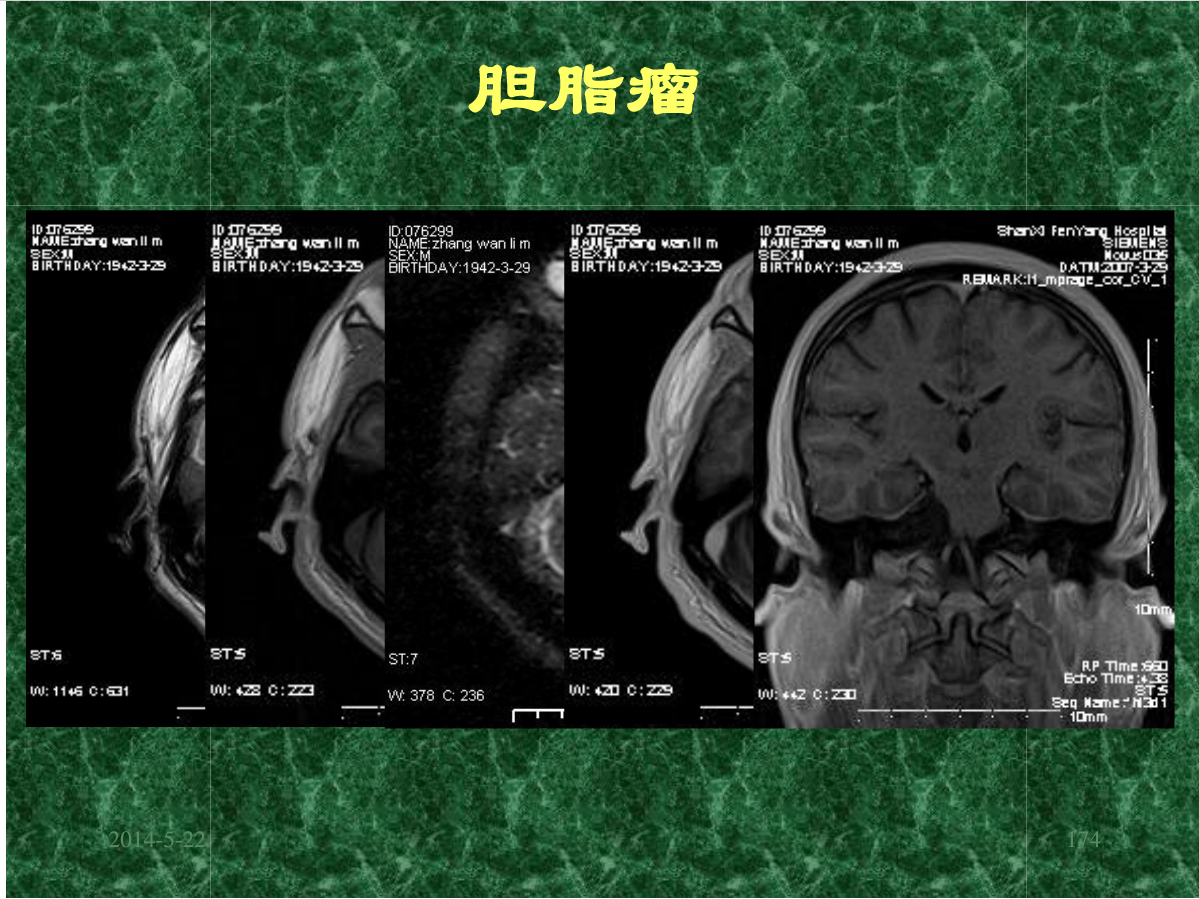 MRI成像在中枢神经系统的应用