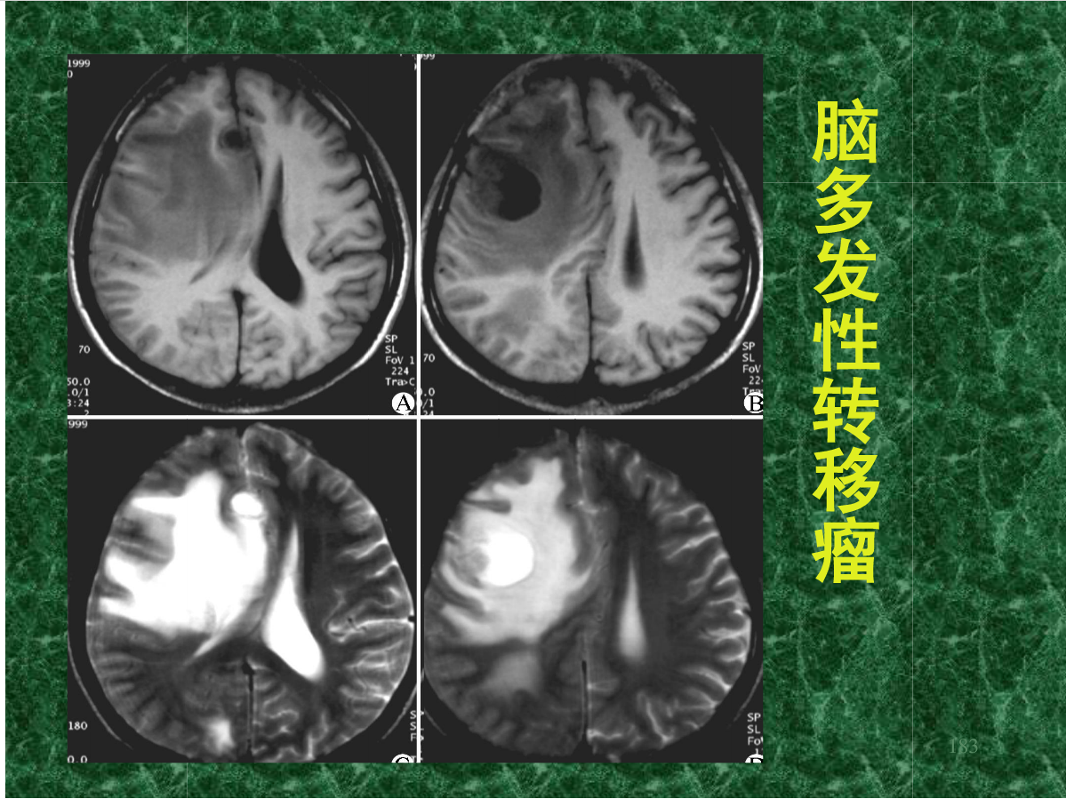 MRI成像在中枢神经系统的应用