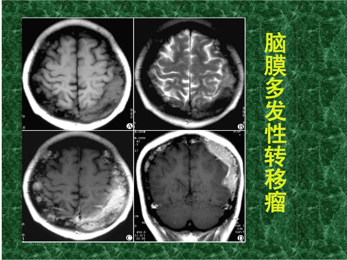 MRI成像在中枢神经系统的应用