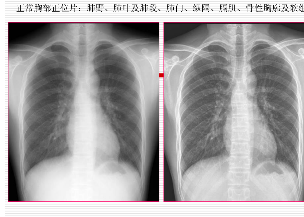 常见疾病的X线与CT诊断学