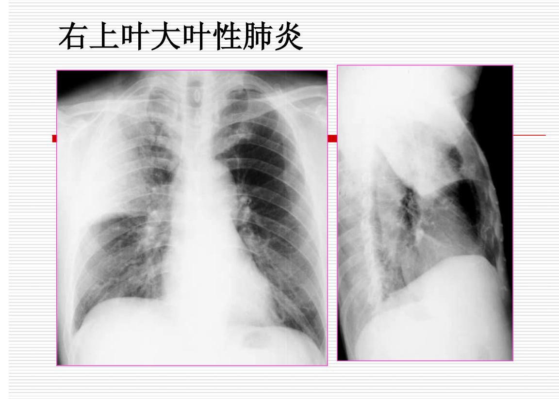 常见疾病的X线与CT诊断学