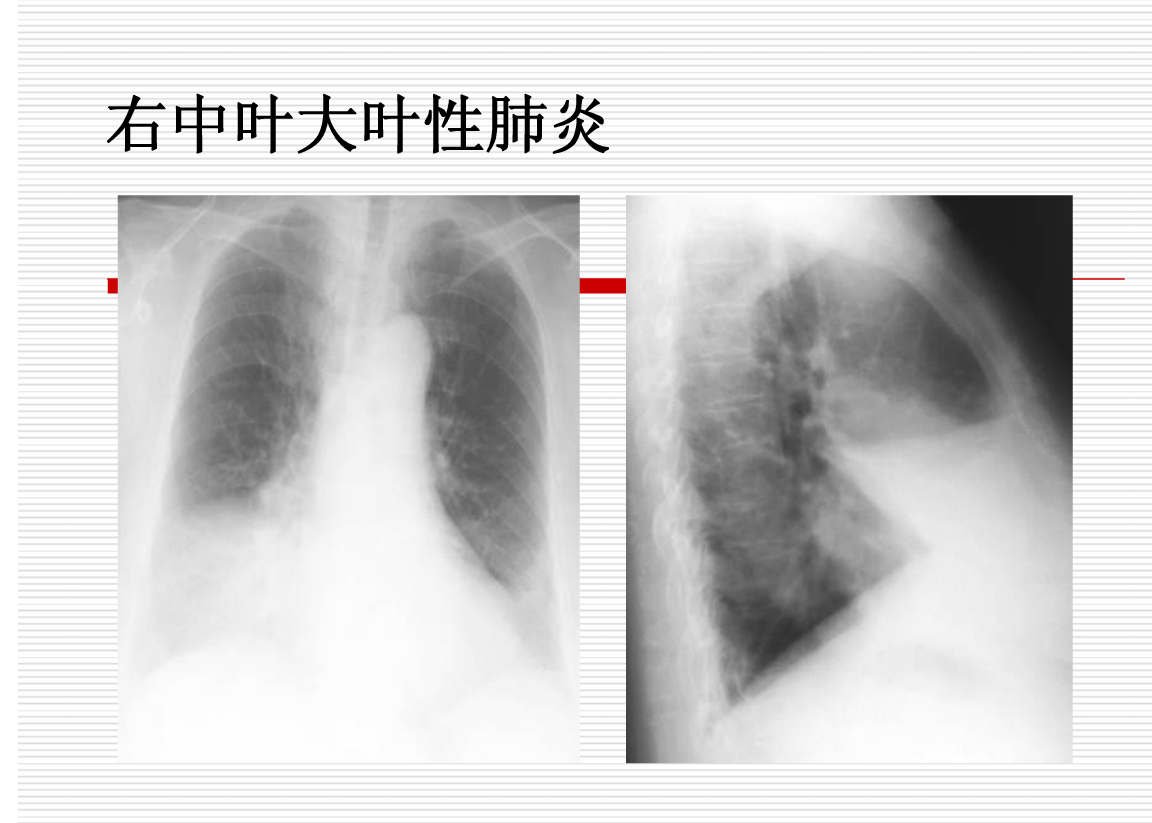 常见疾病的X线与CT诊断学