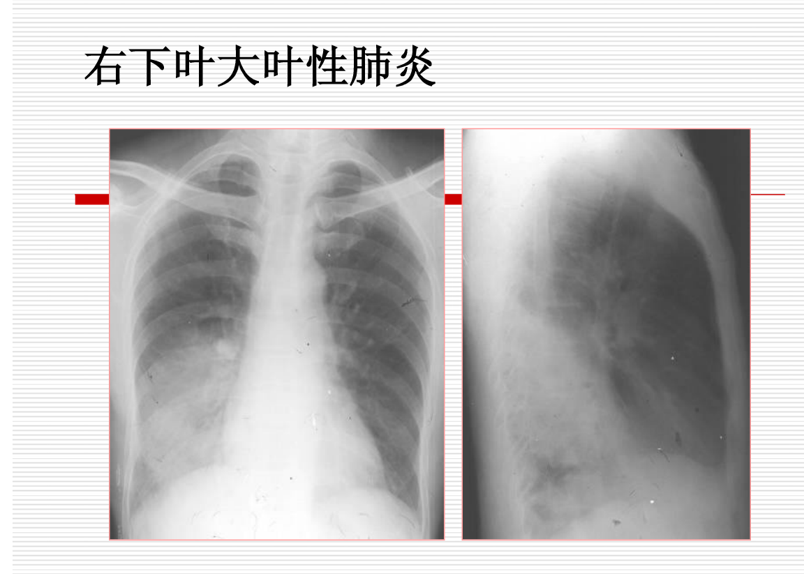 常见疾病的X线与CT诊断学
