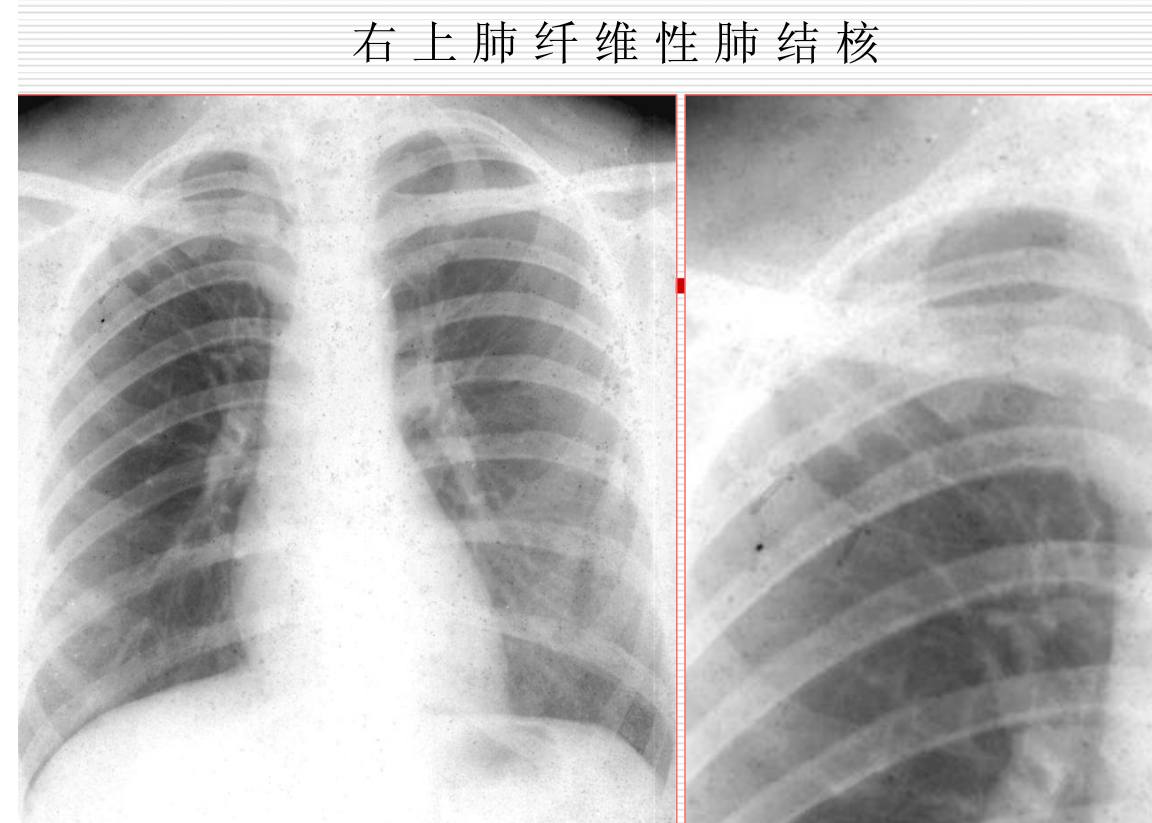 常见疾病的X线与CT诊断学