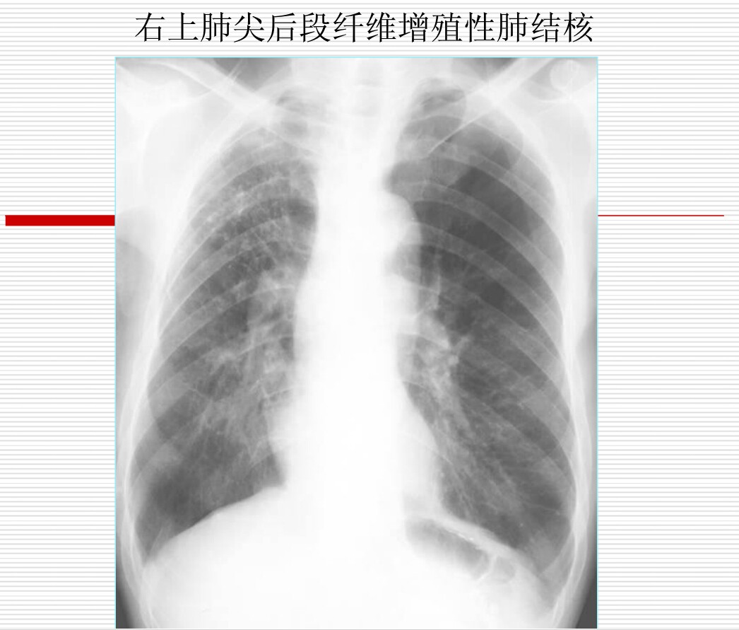 常见疾病的X线与CT诊断学