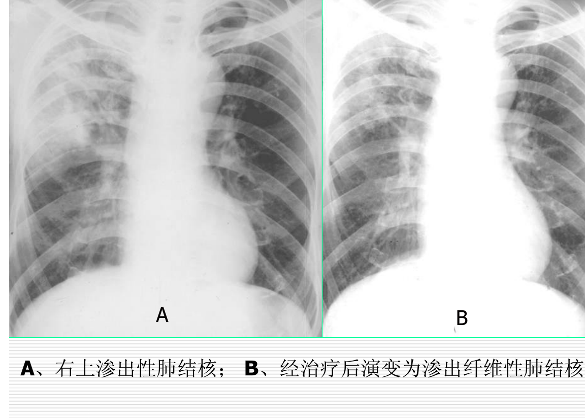 常见疾病的X线与CT诊断学