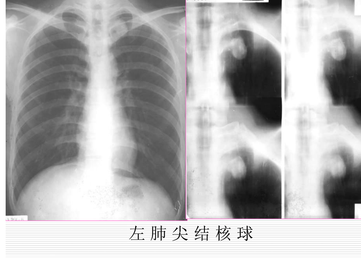 常见疾病的X线与CT诊断学