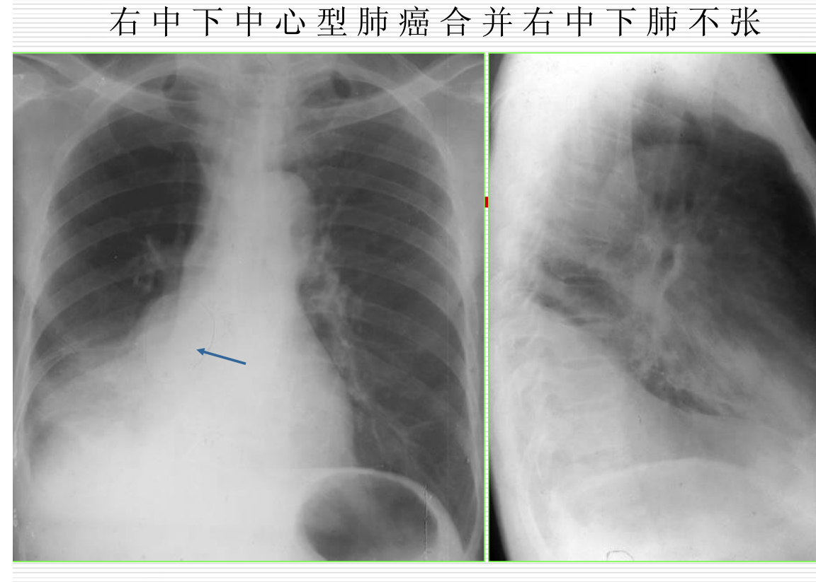 常见疾病的X线与CT诊断学